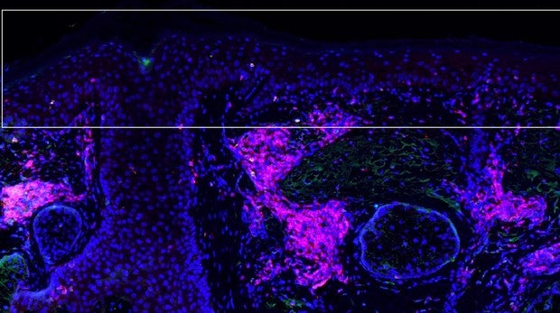 La inmunoterapia ‘en crema’ mantiene a raya el cáncer de piel