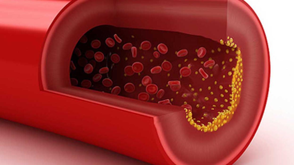 Las placas de colesterol se fijan en el interior de las arterias