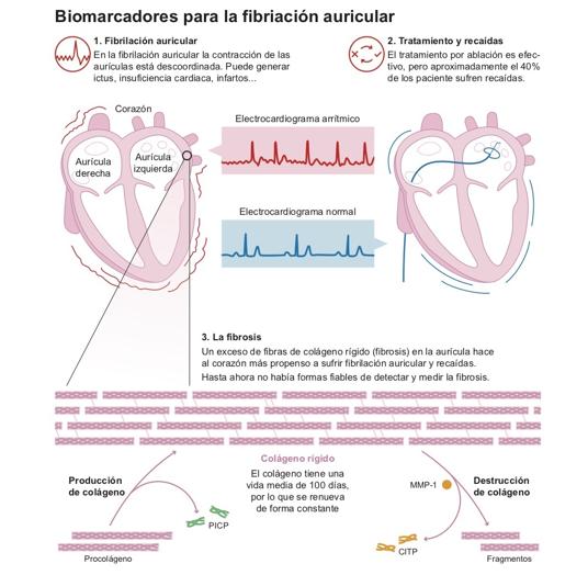 Biomarcadores que predicen el riesgo de fibrilación auricular