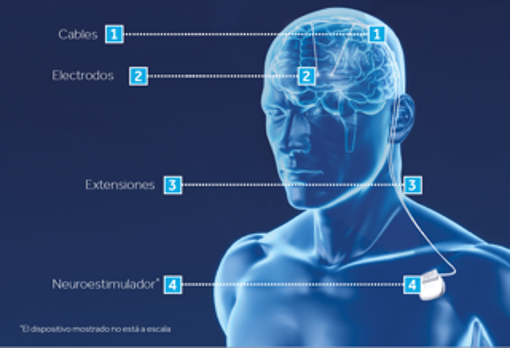 Más del 85% de los pacientes con Parkinson mejoran sus síntomas gracias a la Estimulación Cerebral Profunda