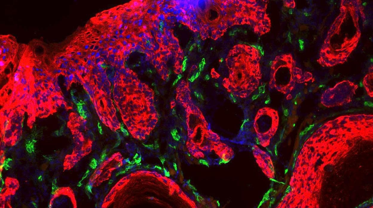 Un tumor al microscopio con las células tumorales (rojo) y los vasos sanguíneos que le proporcionan nutrientes (en verde)