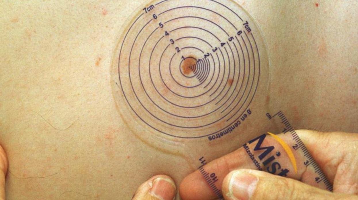 Los melanomas suelen tener unos bordes irregulares y el color se modifica con el tiempo