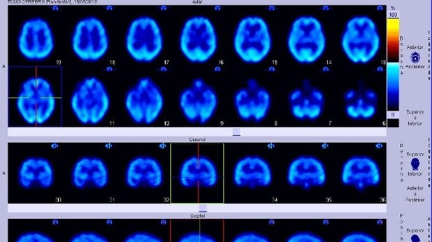 Asocian la extracción del apéndice con el desarrollo de la enfermedad de Parkinson