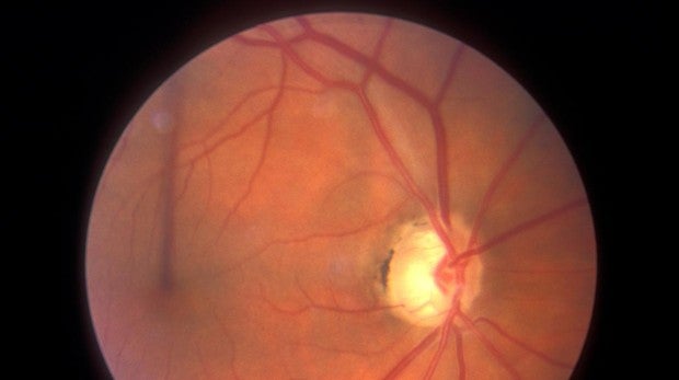 Las estatinas reducen el riesgo de glaucoma