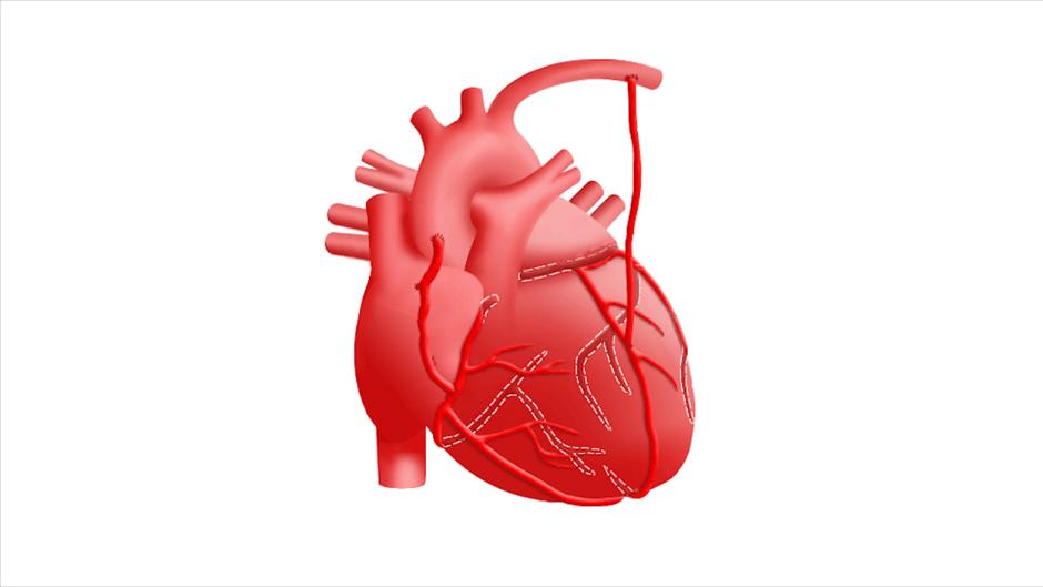 Cuándo está indicado un «bypass» coronario