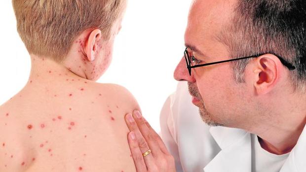 La OMS certifica que Reino Unido, Grecia, Albania y Chequia ya no están libres de sarampión