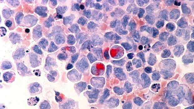 Investigadores españoles diseñan una nueva terapia génica para la anemia de Fanconi