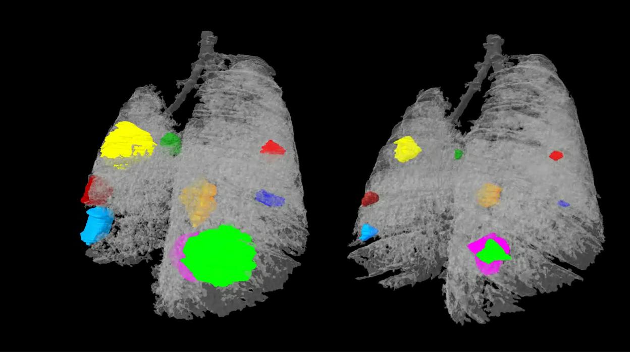 Pulmón de ratón antes y después del tratamiento con una nueva estrategia de tratamiento de tres fármacos, y cada color representa un tumor distinto.