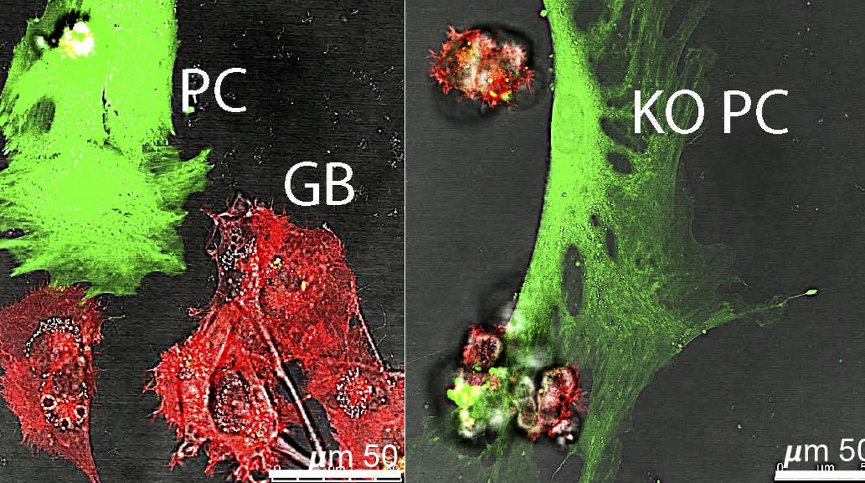 Imágenes de microscopía de fluorescencia de un tumor en cultivo formado por células cancerígenas humanas (GB, en color rojo) y pericitos normales (WT PC, en color verde). Cuando los pericitos tienen mutada la autofagia mediada por chaperonas (KO PC) las células cancerígenas (GB) mueren en el cultivo y no desarrollan el tumor.