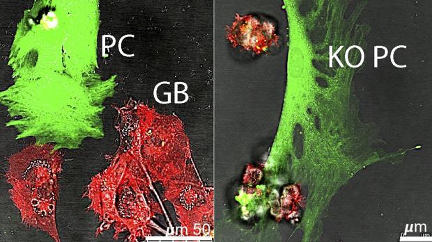 Descubren cómo el cáncer cerebral más mortal ‘engaña’ al sistema inmune