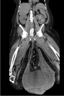 Imagen que ilustra el impresionante edema escrotal y una hernia inguinal masiva
