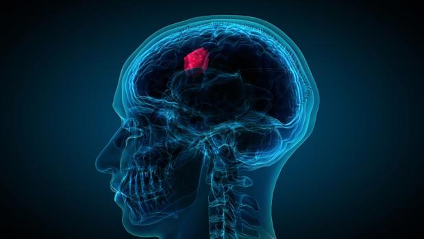 Un análisis de sangre puede predecir el pronóstico en el cáncer cerebral mortal