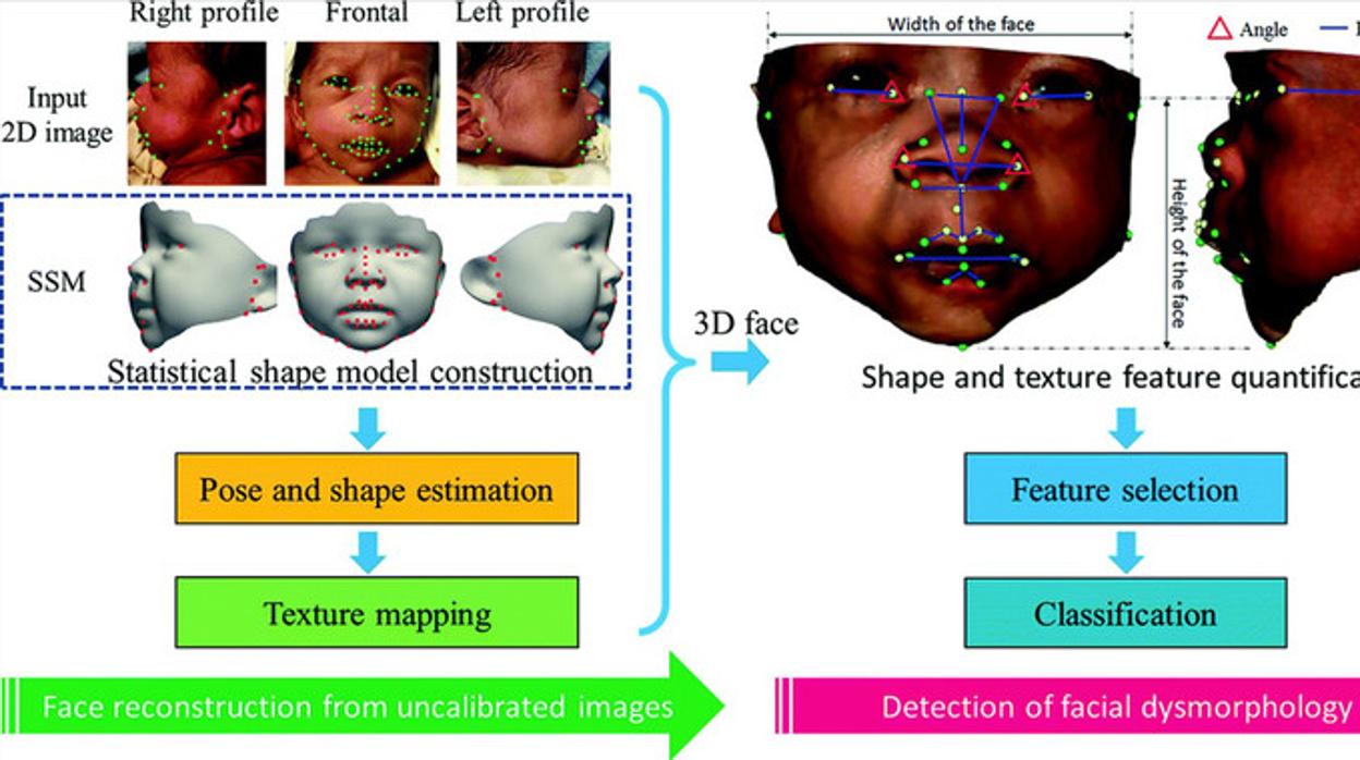 Imagen del método propuesto para la reconstrucción de la cara en 3D e identificación de la dismorfología facial asociada con síndromes genéticos.