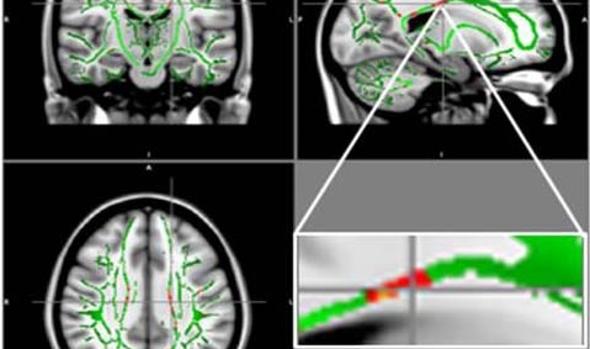 Lo obesidad altera el cerebro de los adolescentes