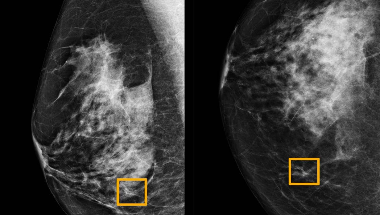 Un cuadro amarillo indica dónde un sistema de IA encontró cáncer escondido dentro del tejido mamario. Seis radiólogos anteriores no pudieron encontrar el cáncer en las mamografías de rutina.