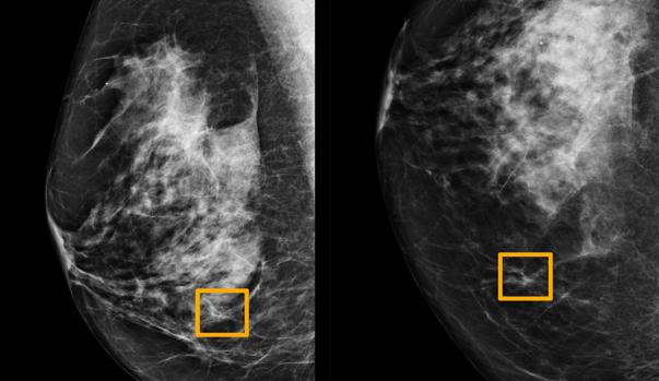 La IA de Google detecta el cáncer de mama mejor que los radiólogos más expertos