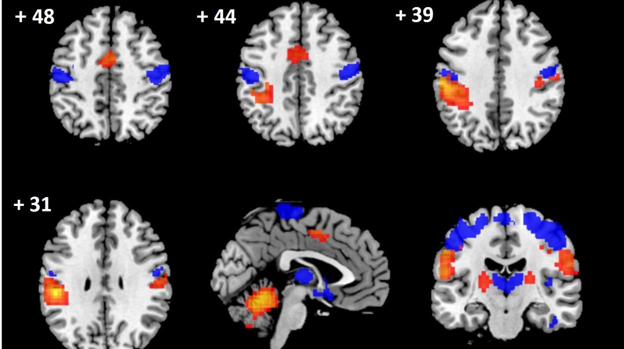 Técnicas de neuroimagen