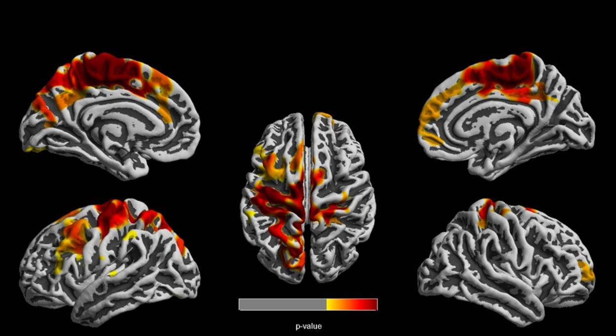 Estas imágenes cerebrales de niños de 12 años muestran regiones del cerebro en rojo, naranja y amarillo que son las más afectadas por la contaminación del aire relacionada con el tráfico. Esas regiones denotan una reducción en el grosor cortical vinculado al carbono elemental atribuido al tráfico. De estas imágenes, cuanto más oscuro es el color, más fuerte es el efecto.