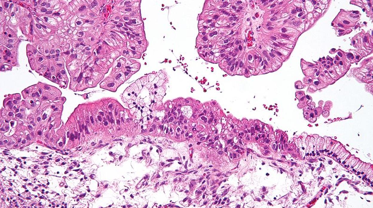 Células cáncer de ovario