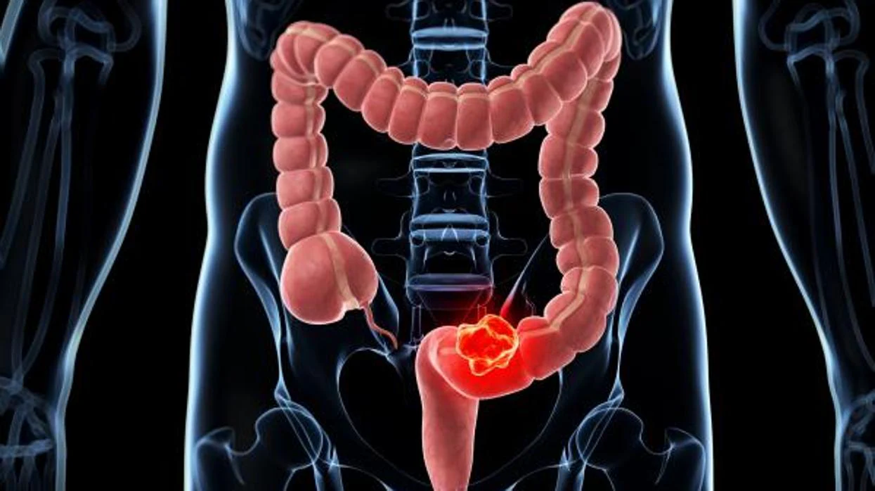 El cáncer de colon es el tumor maligno más frecuente en España