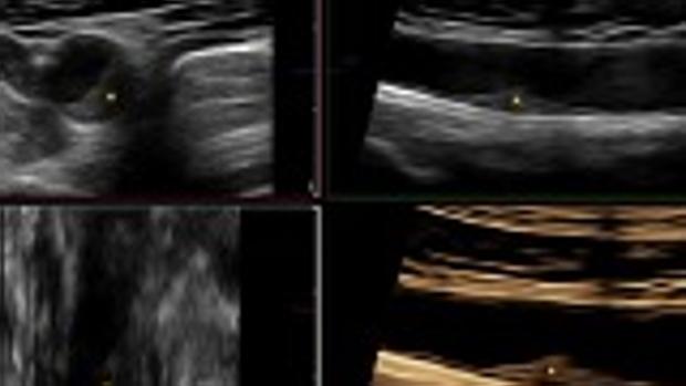 La grasa de las arterias se acumula de forma rápida en personas sanas a partir de los 40 años