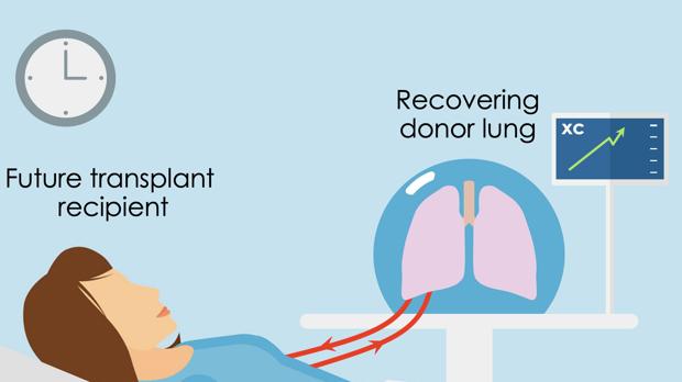 Una técnica recupera pulmones humanos dañados para su uso en trasplantes