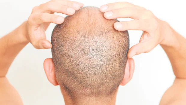 El estrés dispara la alopecia durante la pandemia