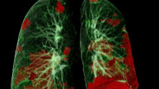 COVID-19: el daño pulmonar y cardíaco mejora con el tiempo