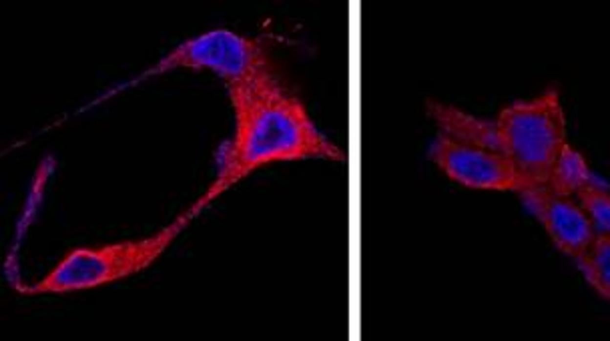 Un nuevo tratamiento para el cáncer de próstata usa nanopartículas orgánicas para destruir las células tumorales