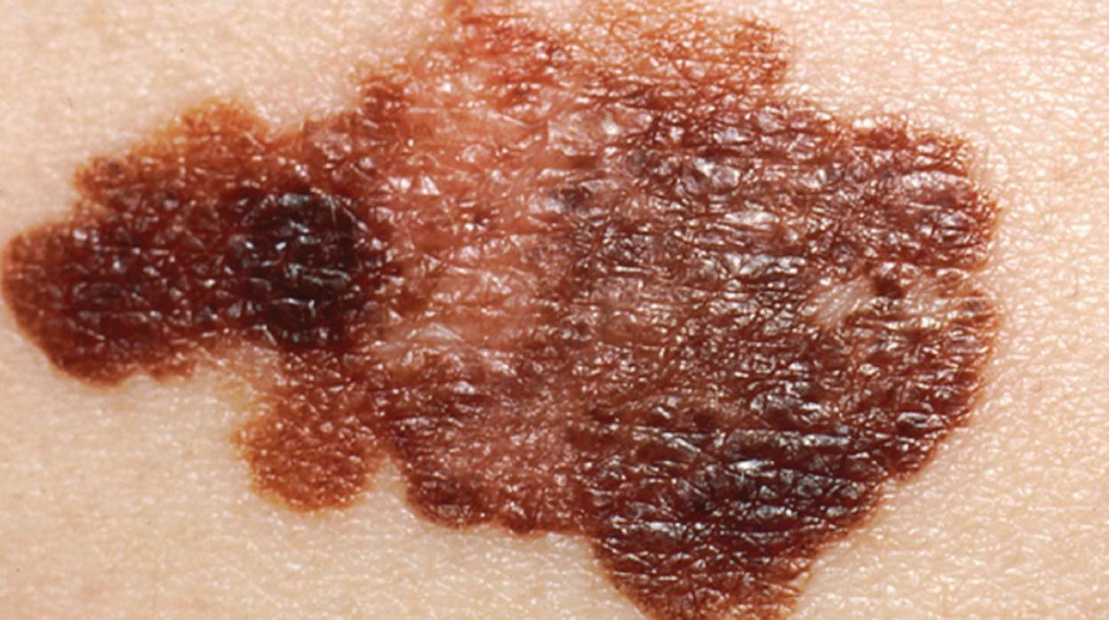 Melanoma