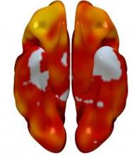 Reconstrucciones 3D de regiones cerebrales superior (izquierda) e inferior (derecha), que muestran regiones con menor metabolismo asociadas con la presencia de placas ateroscleróticas en las arterias carótidas. El código de color indica la magnitud de la observación (amarillo, asociación fuerte; rojo, asociación más baja). El gris indica áreas que no muestran asociación con la presencia de placa carotídea.