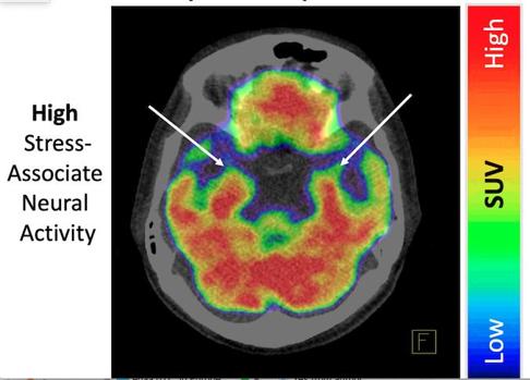 Corazón que con síndrome de Takotsubo