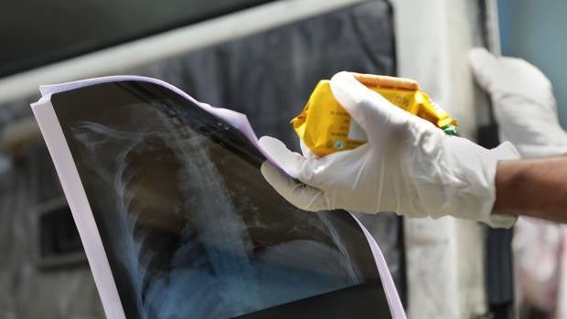 La mayoría de los pacientes con neumonía grave por Covid-19 parece recuperarse por completo