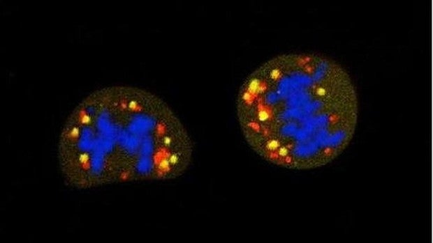 Estás células esconden el cáncer y se activan para producir metástasis