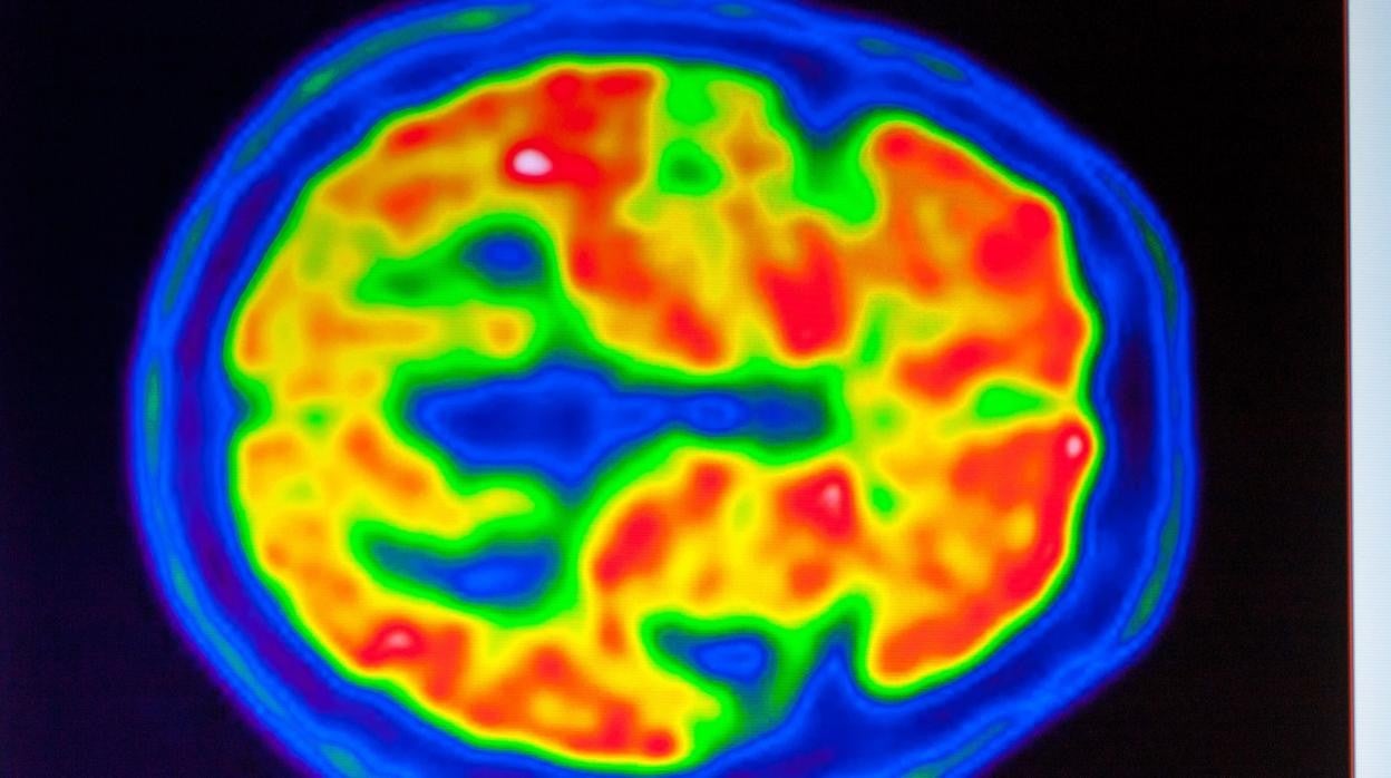 Imágenes PET de cerebro con detección de amiloide por enfermedad de Alzheimer. Las zonas en rojo muestran depósito de amiloide, es una de las proteínas que caracterizan a la enfermedad de Alzheimer..