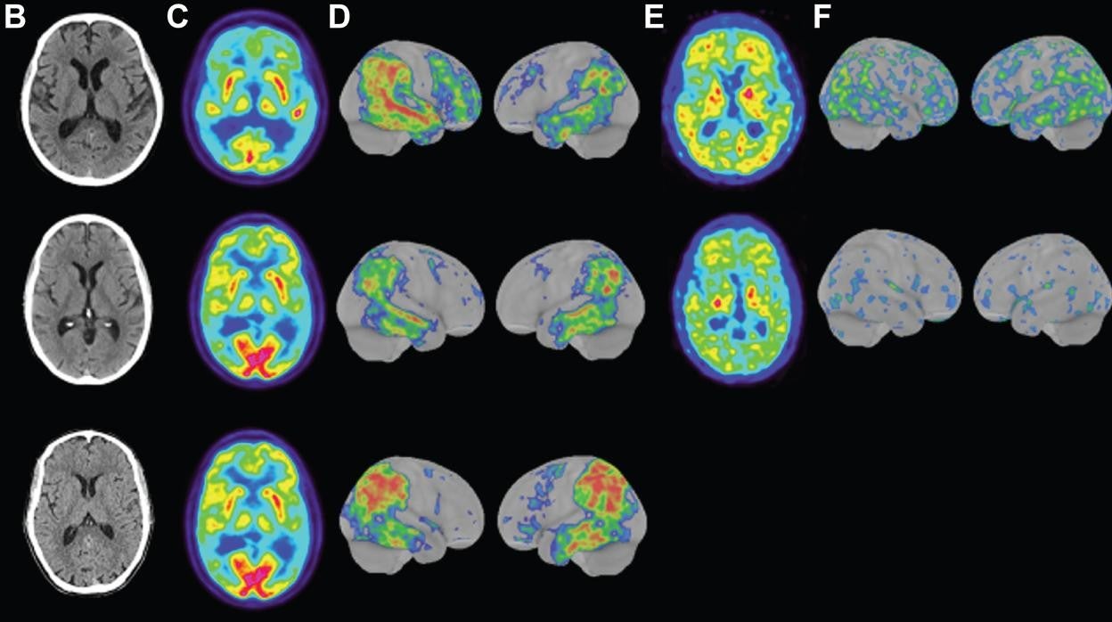 Imágenes de TC del cerebro de dos hermanos y un primo con enfermedad de Alzheimer familiar que albergaba la mutación APP de Uppsala