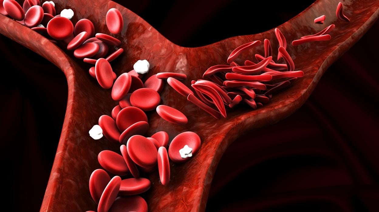 Respresentación de cáncer de la sangre