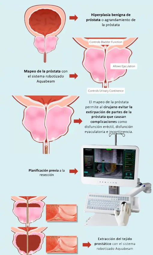 Sistema robotizado Aquabeam para la hiperplasia benigna de próstata
