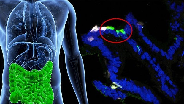 Implantes de células madre fabrican la insulina necesaria para tratar la diabetes tipo 1