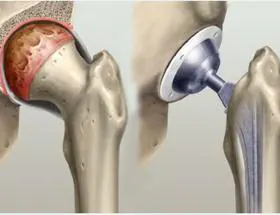Artrosis de rodilla y cadera: cómo evitar la cirugía y cuándo no hay más  remedio