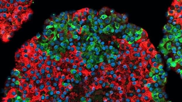 El tratamiento de la diabetes con células madre ya no es ciencia ficción