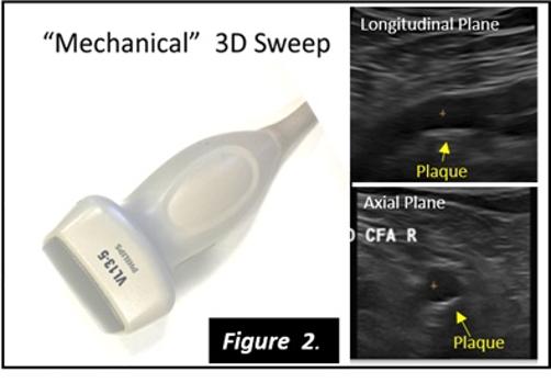 Ecografía 3D matrix, nueva herramienta para prevenir el daño del corazón en personas sanas