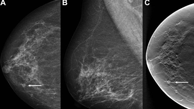 La Inteligencia Artificial ayuda a la detección precoz del cáncer de mama
