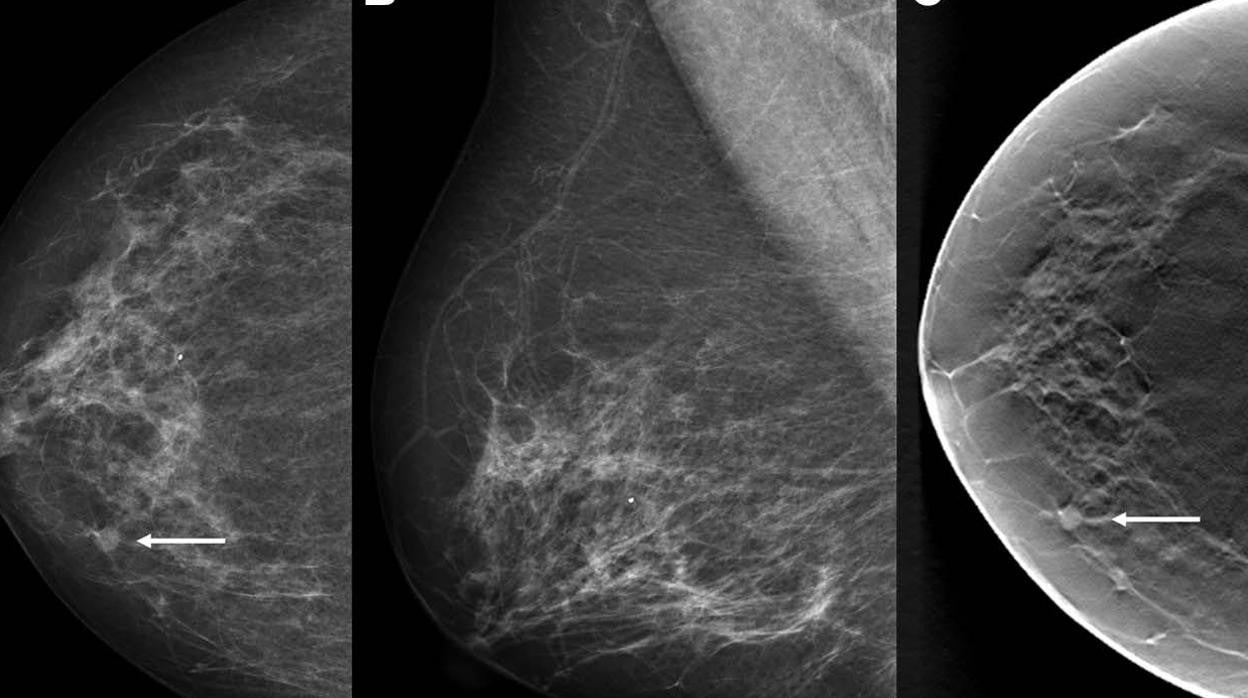 Imágenes de una mujer de 68 años con carcinoma dúctal in situ detectado por cribado con una puntuación de inteligencia artificial (IA