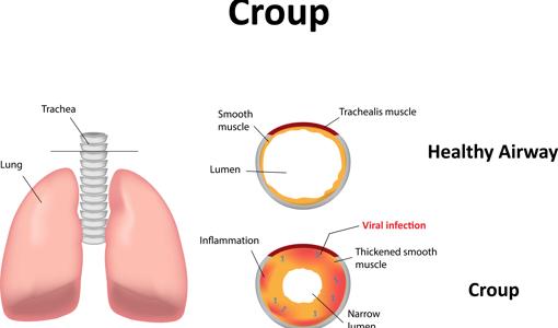 Qué es el crup, el nuevo síntoma en niños de la variante ómicron del Covid