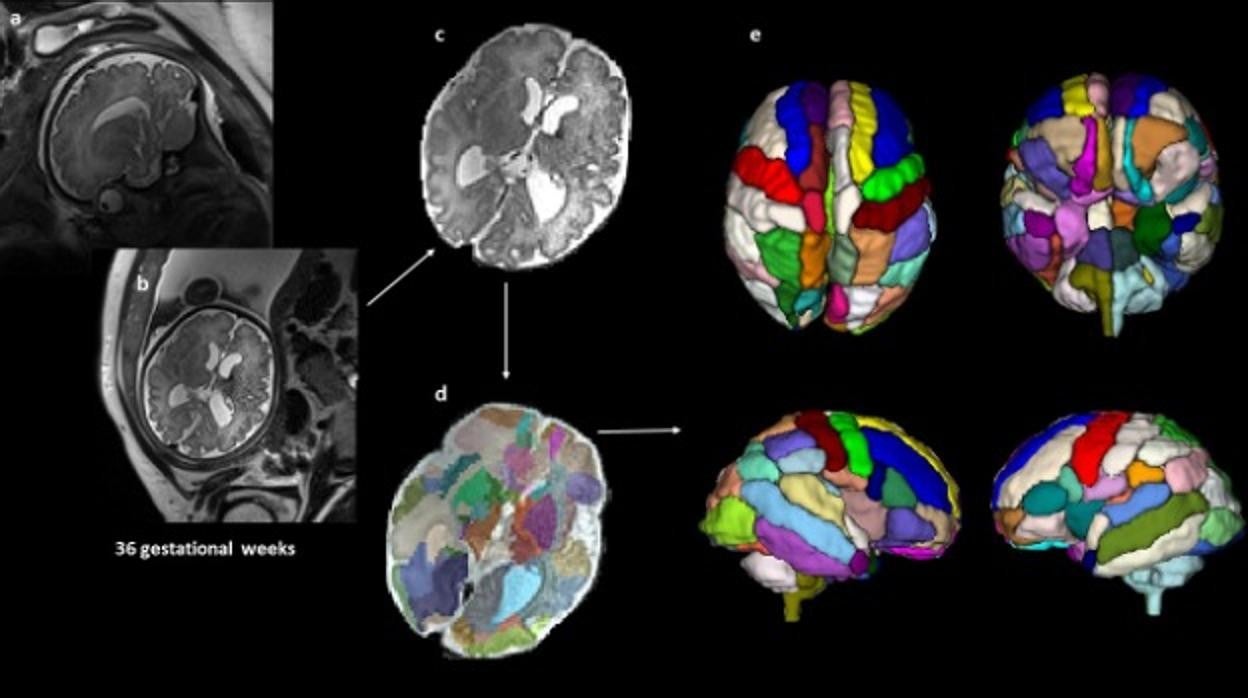 Imágenes representativas del proceso que utilizaron los investigadores para analizar los escáneres cerebrales prenatales