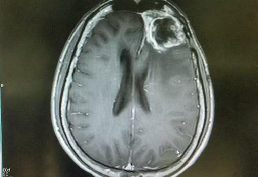 Glioblastoma en zona frontal derecha de un cerebro