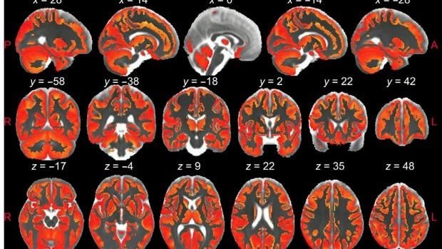 Investigadores españoles ven la inflamación cerebral in vivo por primera vez