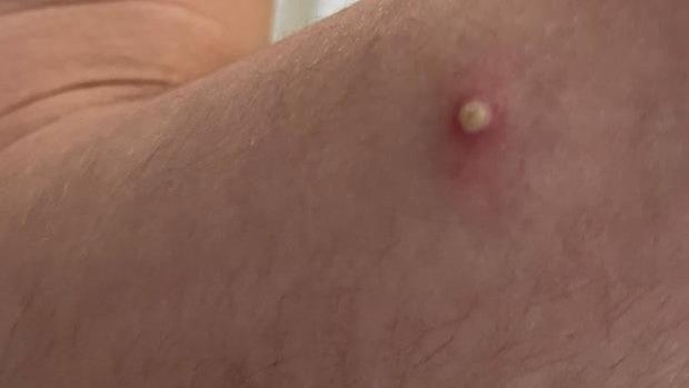 La OMS investiga si la viruela del mono puede transmitirse sexualmente, tras hallar el virus en semen de pacientes