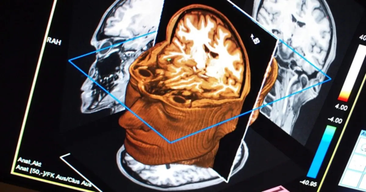 Un escáner puede diagnosticar el alzhéimer precoz con un 98% de fiabilidad